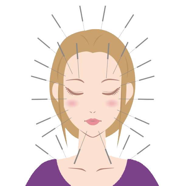 Acupuncture For Migraine Relief: 10 Proven Benefits