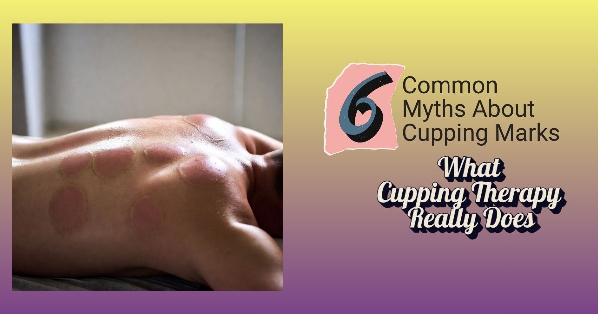 6 Myths About Cupping Marks | Cupping Therapy In Chennai